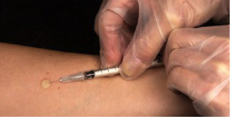 Domani è la giornata mondiale della tubercolosi: Biella prima in Piemonte nella lotta alla malattia