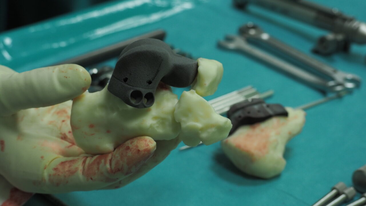 A Biella intervento all’avanguardia: impiantata protesi di caviglia stampata in 3D