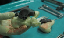 A Biella intervento all'avanguardia: impiantata protesi di caviglia stampata in 3D