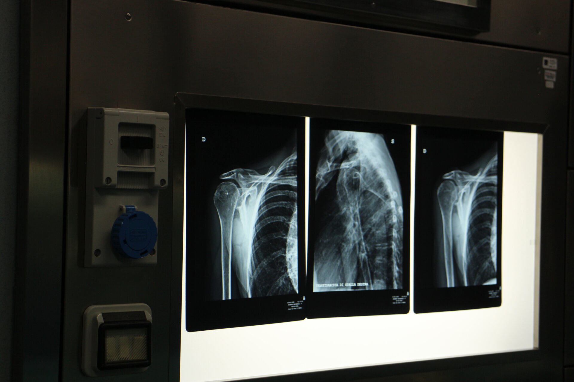 Radiografie spalla