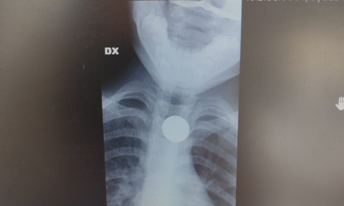 Bimbo ingoia monetina da 2 centesimi. L’agghiacciante racconto della mamma