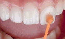 Faccette dentali: cosa sono e quando servono? I principali vantaggi
