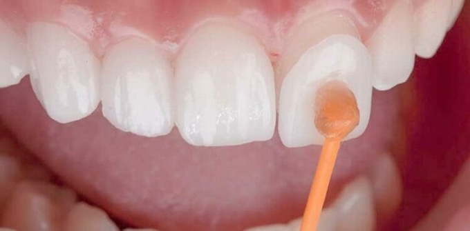 Faccette dentali: cosa sono e quando servono? I principali vantaggi